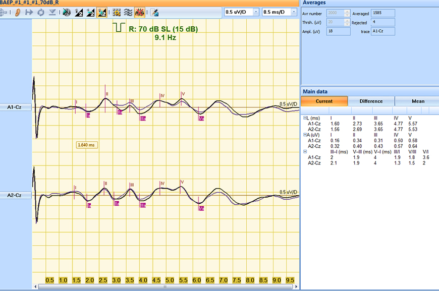 Short-latency evoked potentials (SAEP)