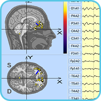 3d localization of epileptiform activity focus in the frontal area