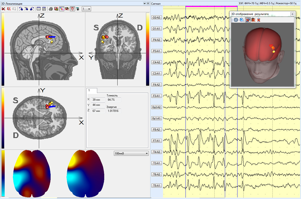 The results of three-dimensional localization of EEG fragments 