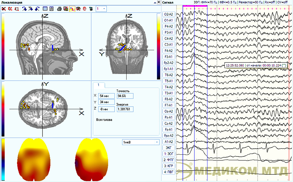 An example of EEG fragment localization with the electrooculgoram influence taken into account