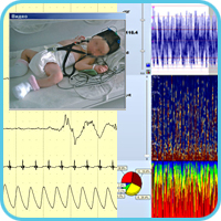 Пример мониторинга церебральной функции у младенца с ГИЭ