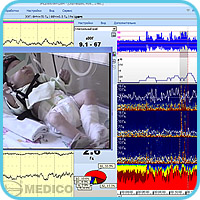 Synchronous cerebral functions and EEG videomonitoring