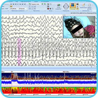 Synchronized EEG monitoring, video image and density spectral array, aEEG and spectral power indices by range