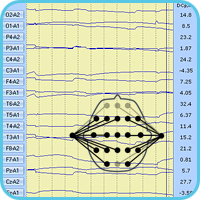 Просмотр сигналов СМА (DCp) в монополярной схеме отведений относительно ушных референтов