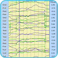Наложение графиков сверхмедленной активности DCp и подэлектродных сопротивлений Rx