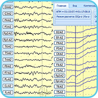 Пример сигналов ЭЭГ и СМА при ФП на гипервентиляцию