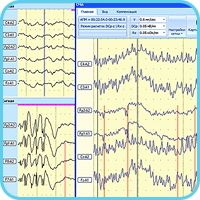 Пример опережающего изменения DCp перед возникновением эпилептиформного разряда