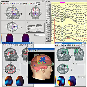 3D Localization of Intracerebral Sources
